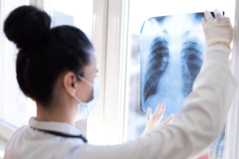 doctor looking at an x-ray from a lung cancer screening